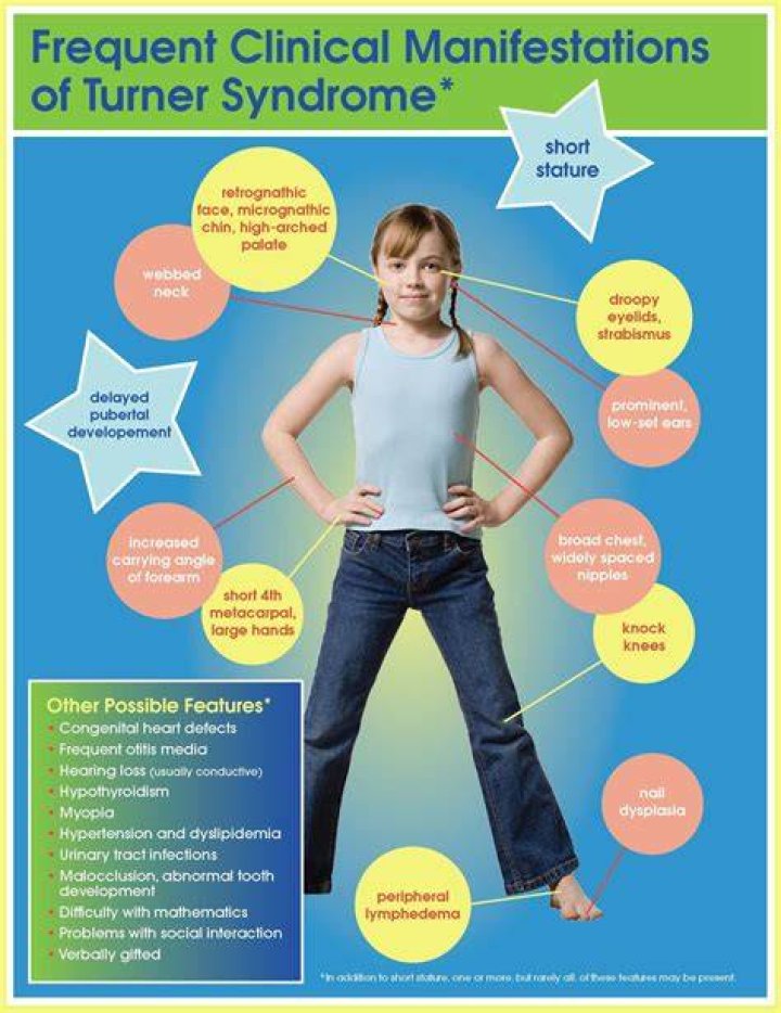 Discoveries In Actors With Turner Syndrome