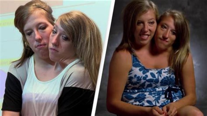 Unlocking The Secrets Of Jackie And Lola Anders Mason: Extraordinary Conjoined Twins