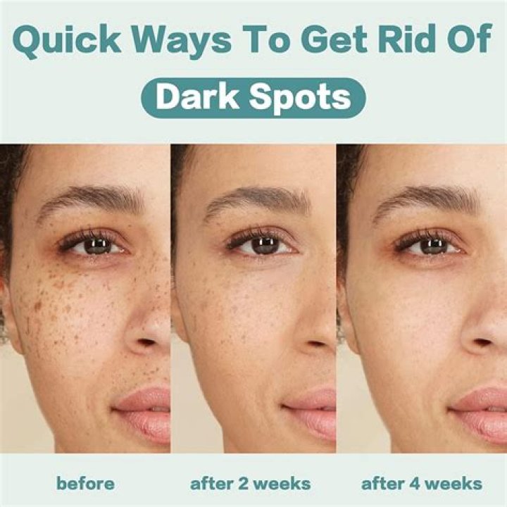 Unveiling Secrets For Dark Spot Transformation